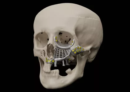 Bone Easy - ICMF - Proteza czaszkowo-szczękowo-twarzowa